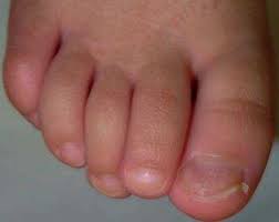 Enfermedades y eventos que presentan onicolisis: Unas Y Enfermedades Sistemicas Piel Formacion Continuada En Dermatologia