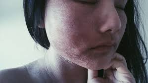 Help ITSAN: raising awareness for Red Skin Syndrome