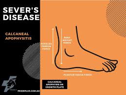 Image result for Calcaneal Apophysitis