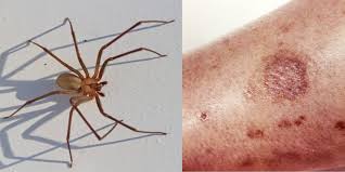 Spider bites in the us usually are harmless, and you can treat them at home, but a bite from a black widow or brown recluse spider can be dangerous, and needs treatment symptoms of a black widow or brown recluse spider bite are nausea, vomiting, fever, headache, and joint or abdominal pain. How To Treat A Spider Bite And When To Seek Medical Attention