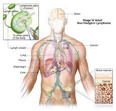 The growth of cancerous lymph nodes varies depending on the actual histology of. Adult Non Hodgkin Lymphoma Treatment Pdq Patients Siteman Cancer Center