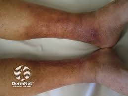 Image result for Lipodermatosclerosis