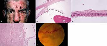 Foundation Volume 3, Chapter 4. Granulomatous Inflammation