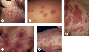 Image result for Erythema Multiforme Major