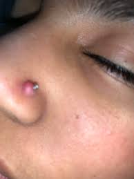 Trauma is the most common cause of a hematoma. If I Take It Off Will My Keloid Go Away Piercing