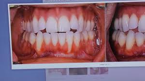 Normal swellingpain and swelling are a normal part of orthodontic work, but they shouldn't continue long term. Gum Recession Orthodontics They Re Connected Youtube