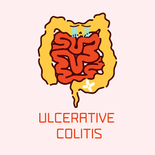 If you're of ashkenazi jewish descent, your risk is even higher. Ulcerative Colitis London Gastroenterology Centre