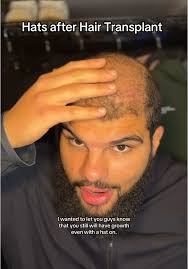 Hair still coming in!!! 🤠 #hairtransplant #hairjourney #hairgrowth  #hairgrowthjourney