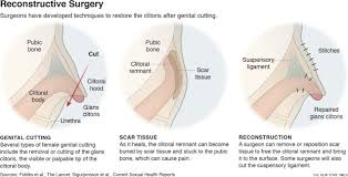 What are the external parts? The Medical Solutions For Women Living With Female Genital Mutilation