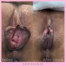 婦人科形成症例写真 | 新宿にある美容外科、美容皮膚科、婦人科形成