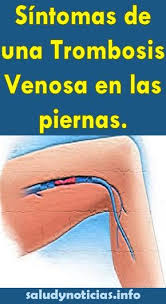 Que es una trombosis venosa en la pierna. Pin En Ejercicios