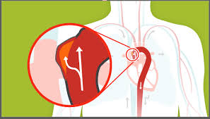 Types Of Aneurysms American Heart Association