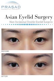 Asian Eyelid Surgery Eyelid Surgery Asian Plastic Surgery Double Eyelid