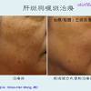 刮痧) or kerokan, is part of traditional chinese medicine (tcm) in which a tool is used to scrape people's skin in order to produce light petechiae. 1