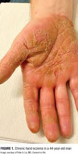Image result for Hand Dermatitis