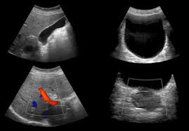 A transabdominal ultrasound is done over the lower belly region, to look for large uterine fibroids, problems with fertility and other issues. Abdominal Ultrasound For Men By Ultrasound Direct