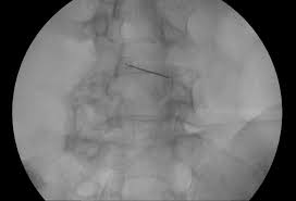 Infiltration Orthopade Salzburg Dr Med Univ Planitzer Alexander Msc
