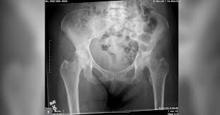 It forms in cartilage cells, usually in flat bones such as the blade, hip, or pelvis. A 71 Year Old Woman With Worsening Left Hip Pain That Became Acutely Severe
