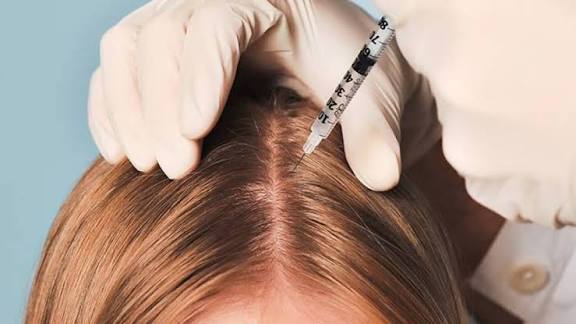 فوائد الميزوثيرابي للشعر | اهم ما تحتاج معرفته قبل جلسات العلاج