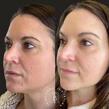 🌟✨ Discover Combination Therapy Magic! ✨🌟 Experience ultimate skin  transformation with our blend of injectables, lasers, and skincare. 💆‍♀✨ A  collaborative effort from Kit (@kitsbodytonic ) and Iris (@irisbodytonic ).  Your radiant,