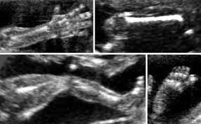 Club foot can't be treated before birth. Skeleton Diagnosis Of Fetal Abnormalities The 18 23 Weeks Scan
