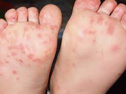 Hand Foot And Mouth Disease In Adults Symptoms And Treatment