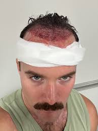 HT na Flórida : r/Hairtransplant