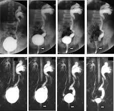 Image result for Voiding Cystourethrogram