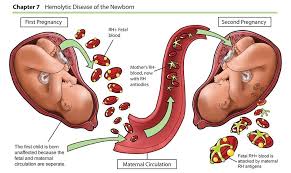Hemolytic Disease Of Newborn Newborn Nursing Neonatology Newborn