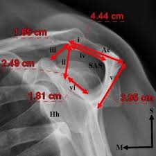 Bigliani type ii anterior acromial process. Acromial Types As Proposed By Bigliani Et Al 1986 A Type I Flat Download Scientific Diagram