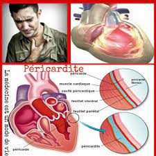 Mar 10, 2021 · pericarditis is classically associated with ecg changes that evolve through four stages. La Pericardite La Medecine Est Un Mode De Vie Facebook