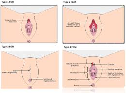 Durchbohren (piercen), einschneiden (introzision), abschaben von genitalgewebe, ausbrennen der. Female Genital Mutilation In Children Presenting To A London Safeguarding Clinic A Case Series Archives Of Disease In Childhood