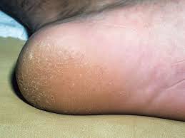 Image result for Pitting nails feet