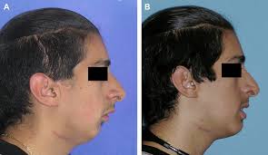 Distraction Osteogenesis for Maxillofacial Surgeons