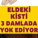 Eldeki Ve Bilekteki Kistlerinden Kurtulma Yolu Saglik Saglik Urunleri Saglik Ipuclari