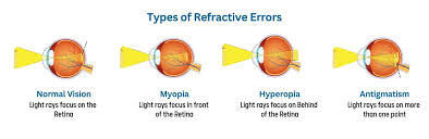Image result for Refractive Error