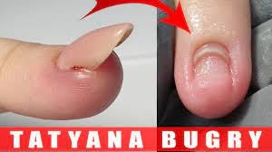 Nail Torn Off Nail Bed Correcting Nails Growing Upward Youtube