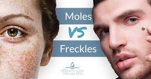 They usually start out looking red and purple, and then they. How To Tell The Difference Between A Mole And A Freckle The Dermatology Specialists