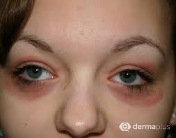 Dafür tauchst du einen sauberen waschlappen in eiskaltes wasser, wringst ihn gut aus und legst ihn auf die augen. Juckreiz Rotungen Und Schwellungen Am Auge Derma Plus