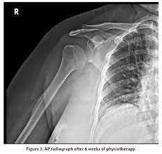 Image result for Shoulder Subluxation