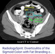 Pin By Liznel Feliberty On Imagenes De Ct Scan Y Mri Pet Ct Ct Scan Radiology