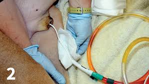 Remember go to www.selfcatheters.com from the accelerated seldinger technique arterial catheter,balloon catheter, broviac catheter, central venous catheter and foley catheter. Urinary Catheters Infection Clinician S Brief