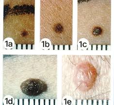 Evolving take note of any new moles or freckles. Spot The Differences Between A Mole And Skin Cancer