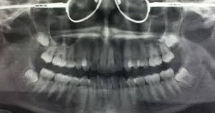 Pin By Reign Dental On X Rays Dental Dental Implants Dental Humor