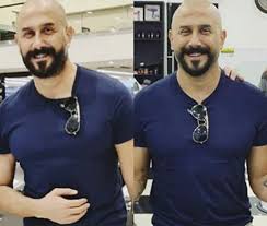 من الواضح أن خولي قد خضع لعملية تعريض الحنك التجميلية، المشهورة باسم عملية تكساس، التي خضع لها من قبل عدد من الفنانين، بينهم المصري تامر حسني، واللبنانية نادين نسيب نجيم. Ø¥ØµØ§Ø¨Ø© Ù‚ØµÙŠ Ø®ÙˆÙ„ÙŠ ØªØ«ÙŠØ± Ø§Ù„Ø¬Ø¯Ù„ Ø£Ø«Ù†Ø§Ø¡ Ø§Ù„ØªØµÙˆÙŠØ± Ù†ÙˆØ§Ø¹Ù…