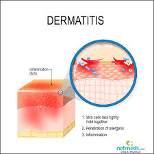 Discover in just 7 short questions why you may. Contact Dermatitis Causes Symptoms And Treatment Netmeds