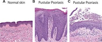 Image result for Pustular Psoriasis