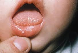Les aphtes sont des lésions souvent rencontrées au niveau de la bouche , ce sont des lésions ulcéreuses et non pas érosives car elles touchent l'épithélium. Les Aphtes Causes Et Traitements