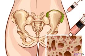 Maybe you would like to learn more about one of these? Bone Marrow Biopsy Pain Procedure Results Factdr