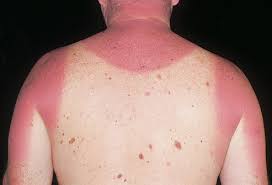 30 Sunburn Home Remedies For Pain Blisters And Inflammation